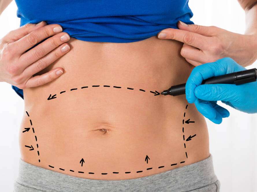 Abdominoplasty in Islamabad