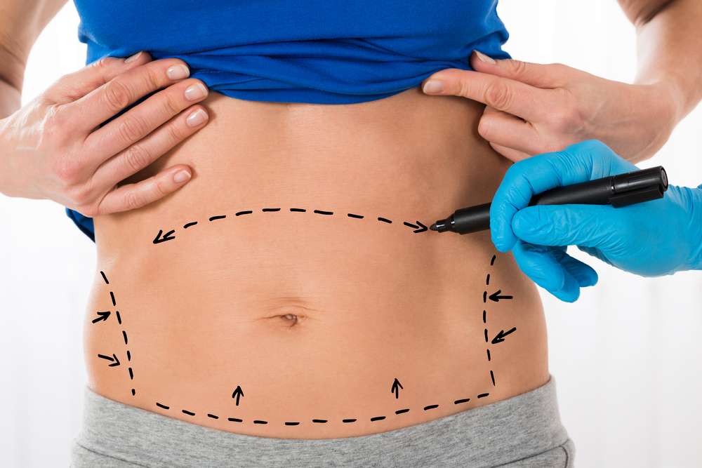 Abdominoplasty in Islamabad