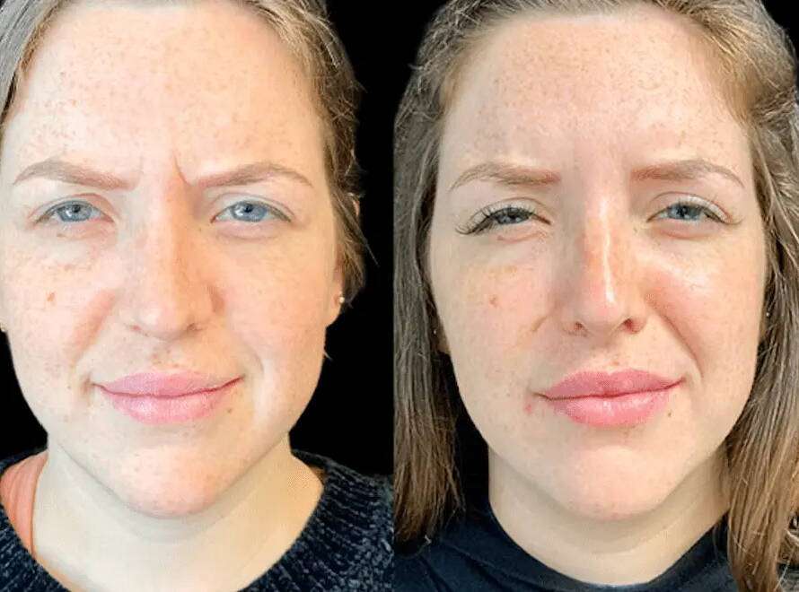 Botox in Dubai