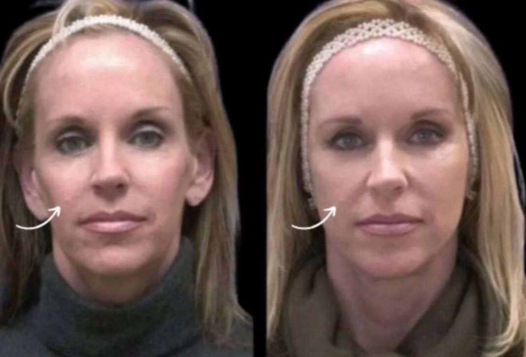 sculptra fillers in dubai