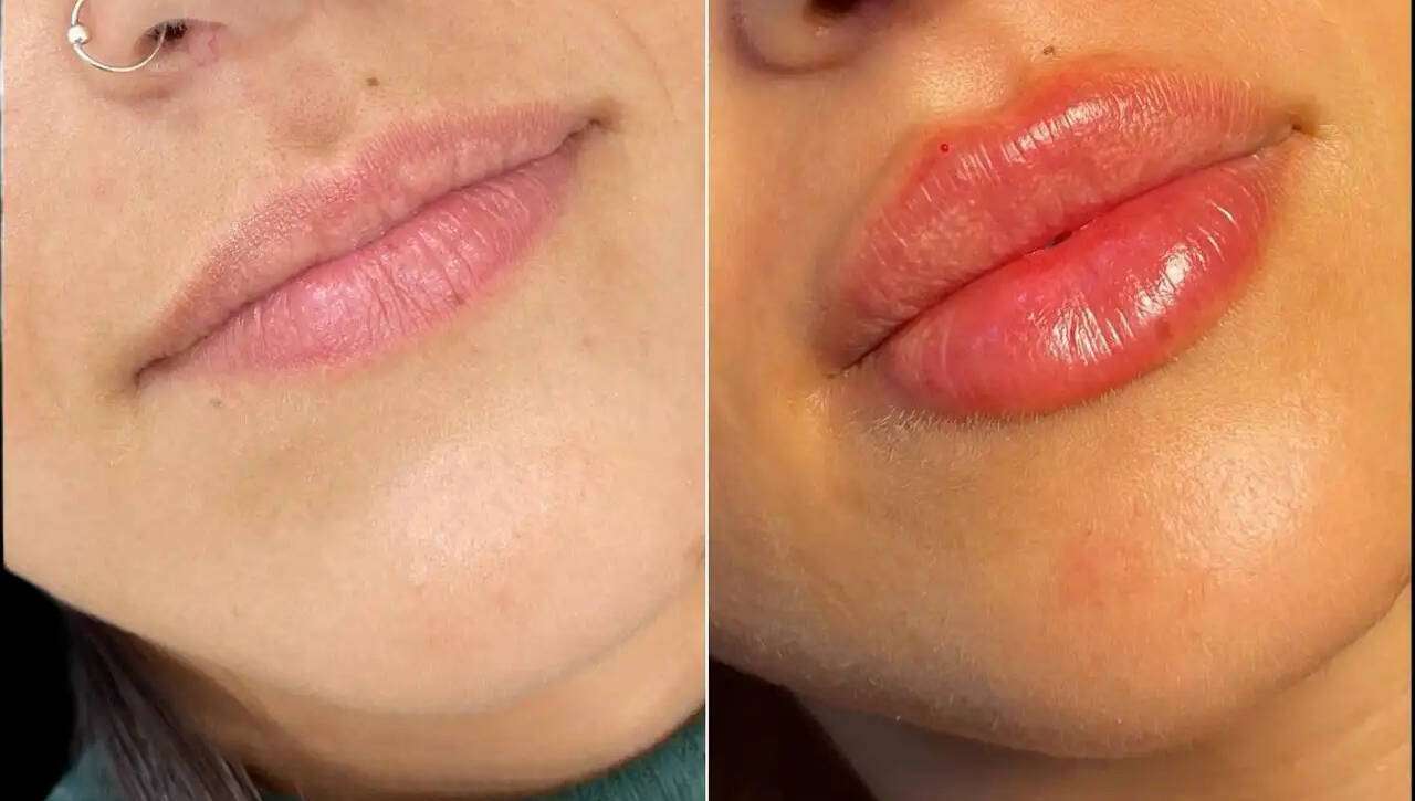 dermal fillers