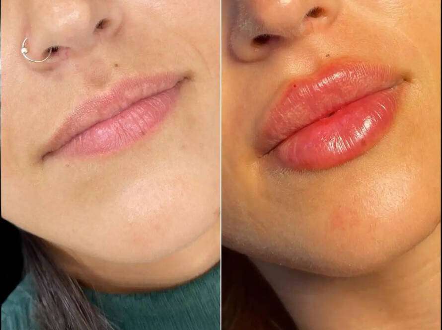 dermal fillers