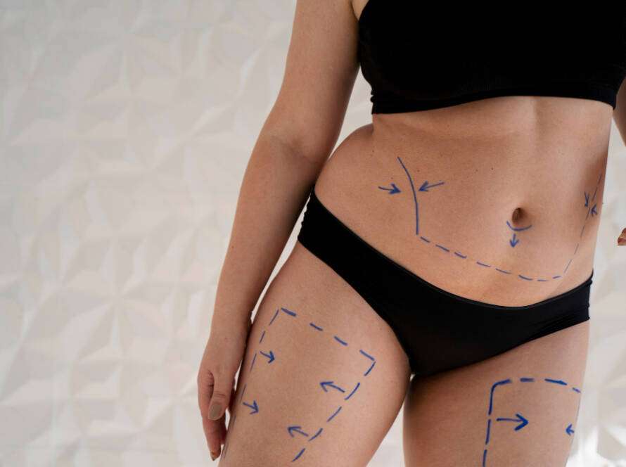Liposuction in Dubai