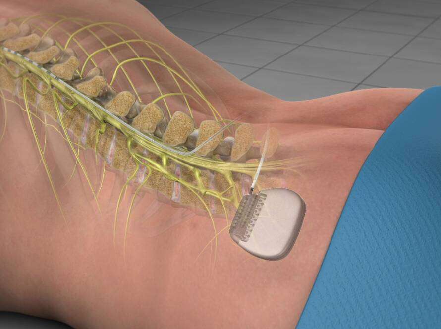 Spinal Cord Stimulator