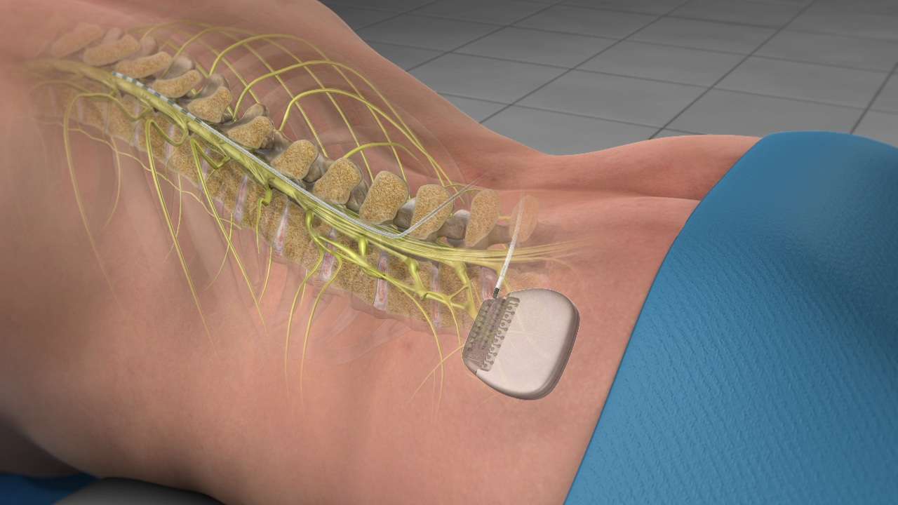 Spinal Cord Stimulator