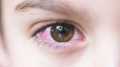 Urgent Care for Stye