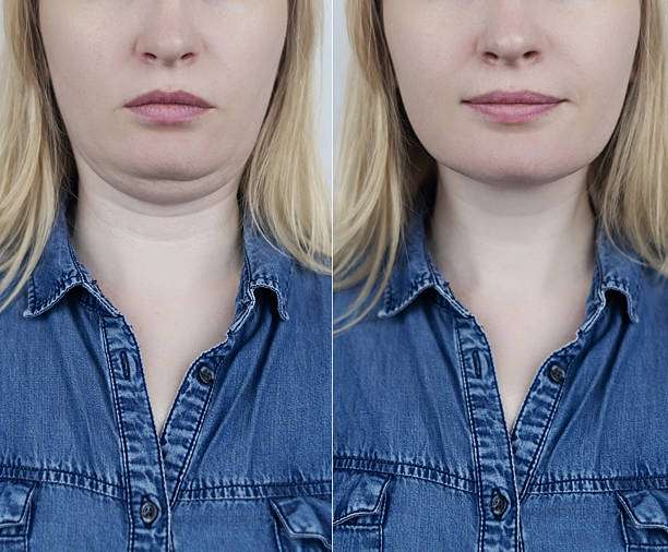 Double Chin Removal in Abu Dhabi