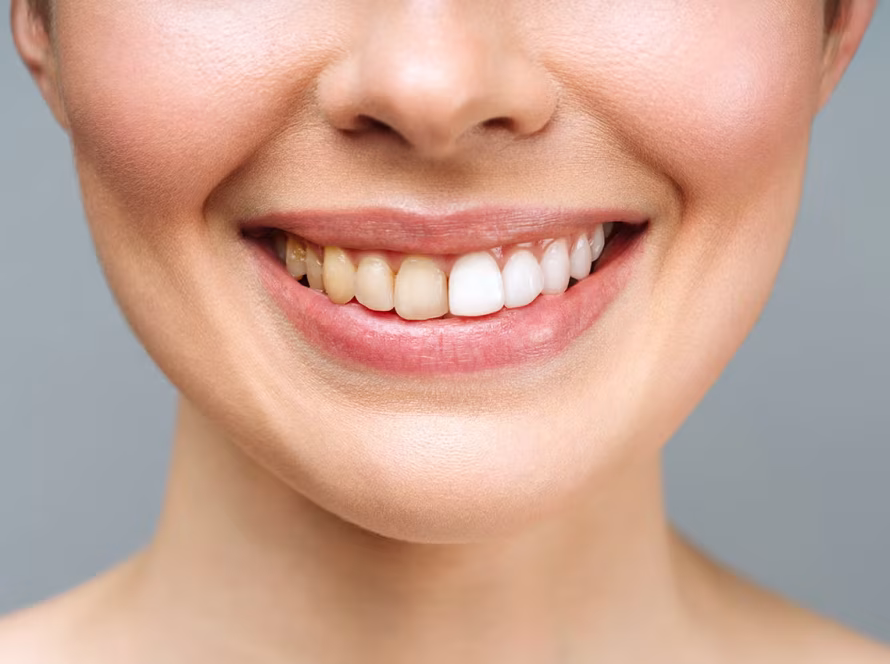 Causes of Tooth Discoloration