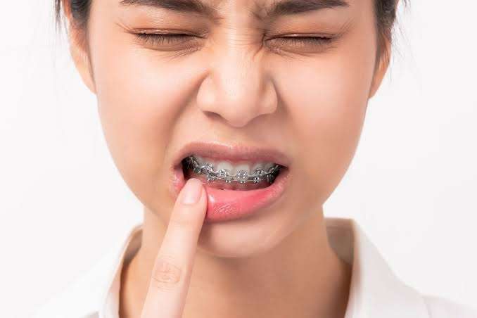 Common Braces Problems and How to Handle Them
