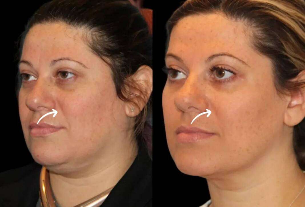 sculptra in dubai