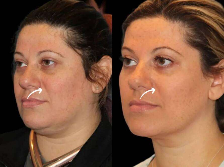sculptra in dubai