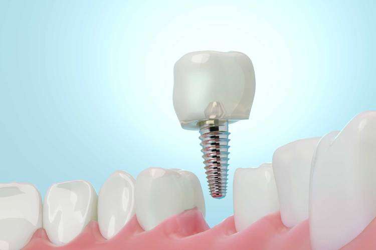 Dental Implants in Houston
