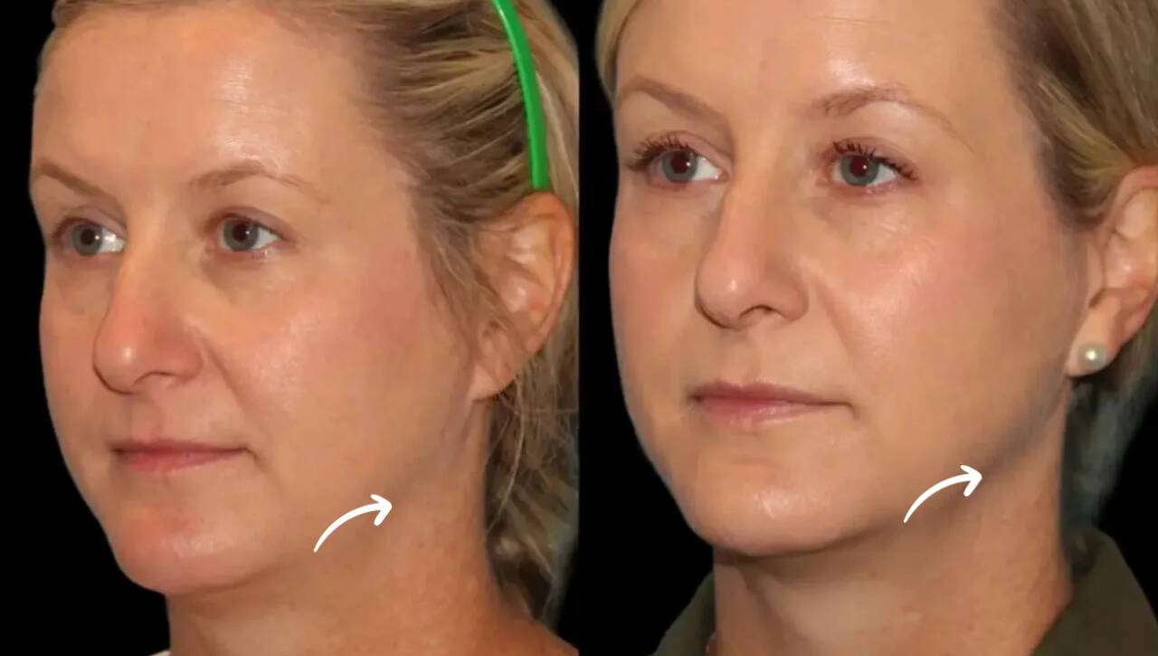 sculptra in dubai