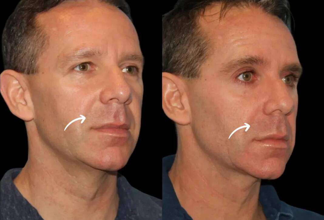 sculptra in dubai