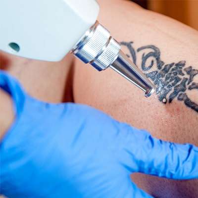 Expectations for Your PicoSure Tattoo Removal in Dubai