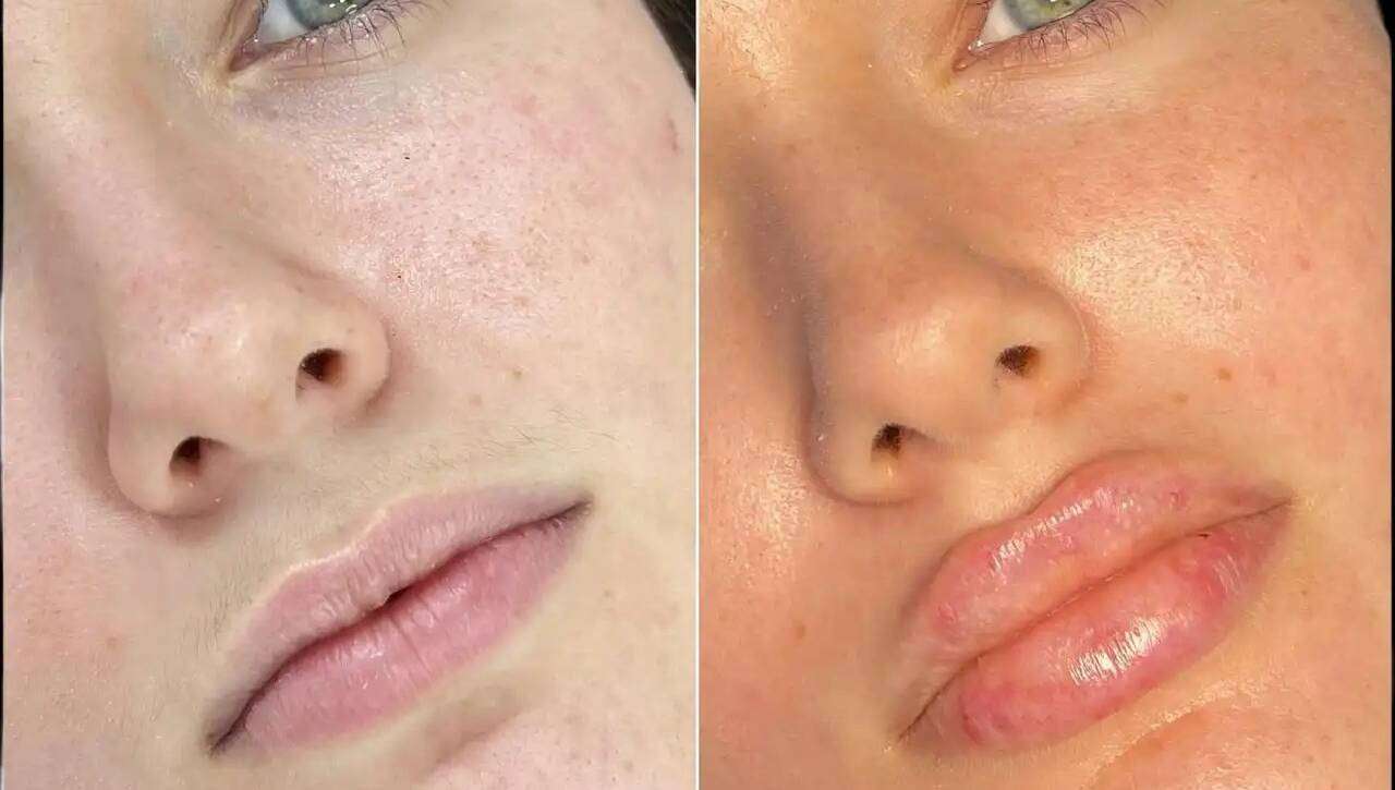 Dermal Fillers in Dubai