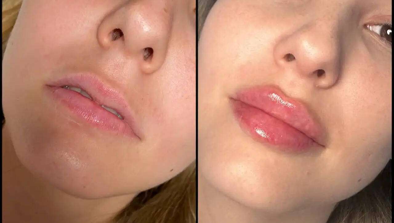 Fillers in Dubai