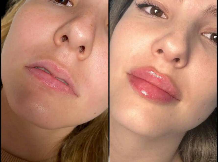 Fillers in Dubai
