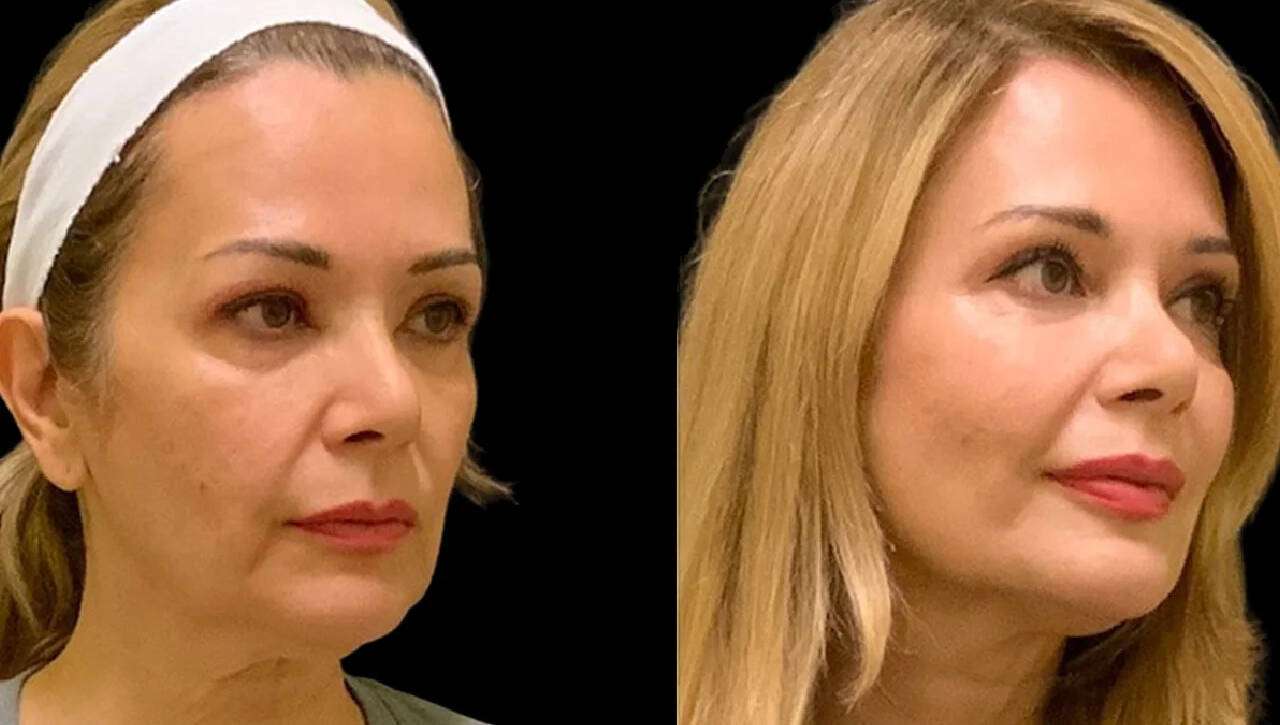 Cheek Fillers in Dubai