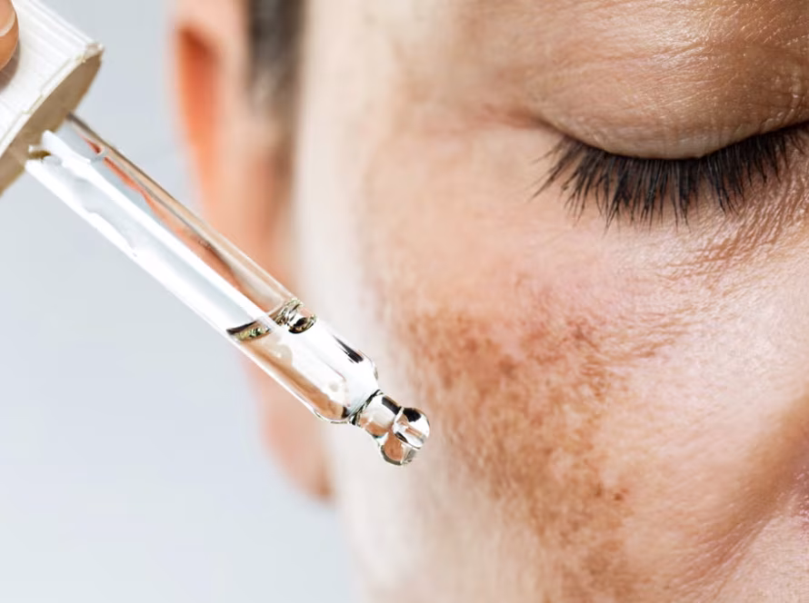 How to Choose the Right Melasma Treatment