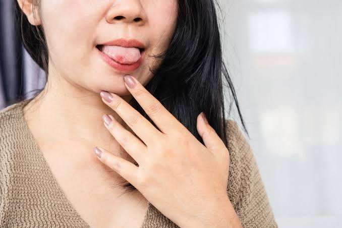 Burning Mouth Syndrome Remedies