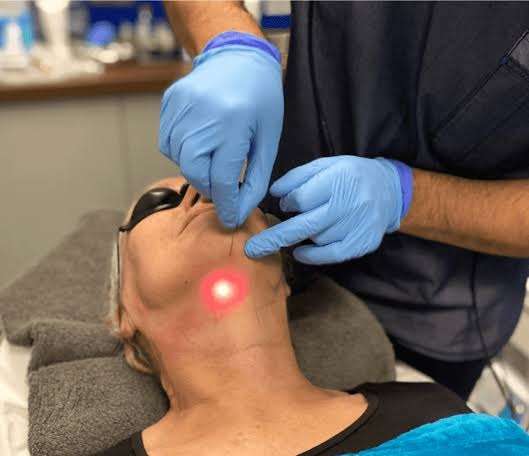How Does Endolift Improve Skin Firmness