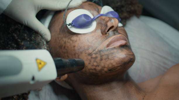 How Does Laser Carbon Peel Improve Skin