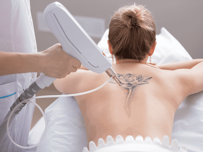 How Does Laser Tattoo Removal Target Ink