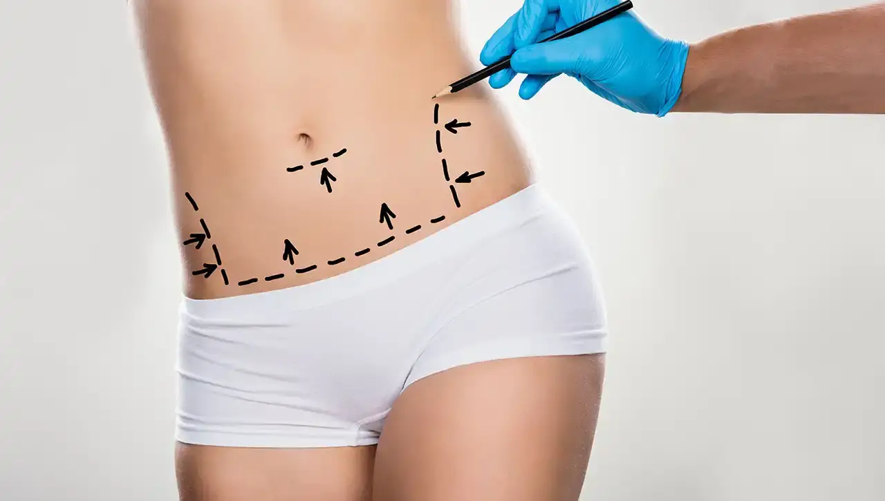 How can Mini Abdominoplasty enhance your abdominal profile