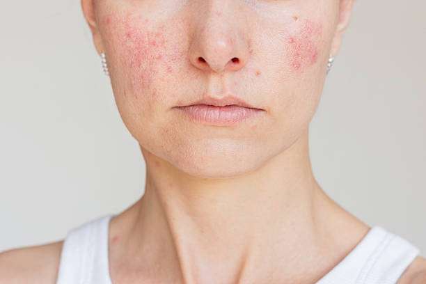 How does Acne Treatment target common skin concerns