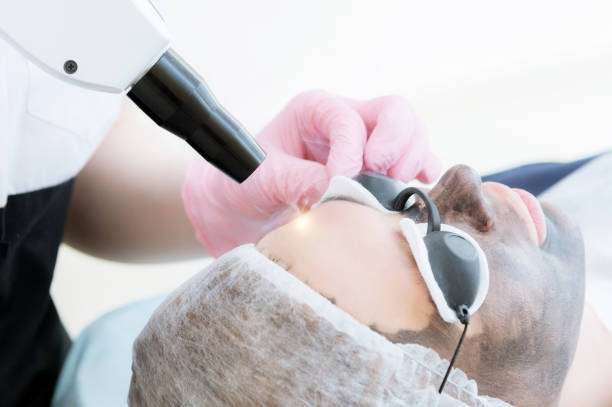 What Can Laser Carbon Peel Do for Large Pores
