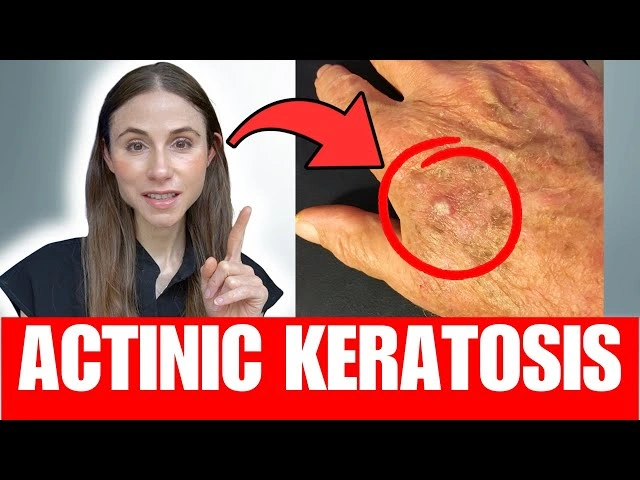 What Are Actinic Keratosis Signs and Symptoms on Sun-Damaged Skin