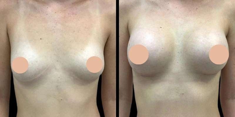 Breast augmentation in dubai
